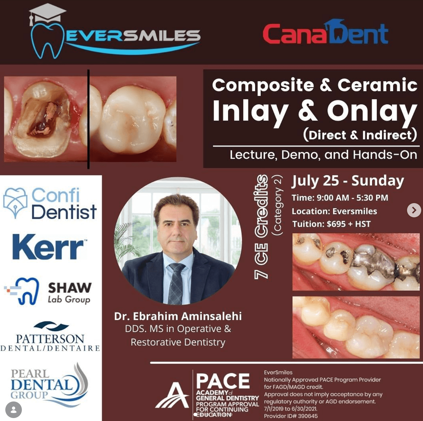 Composite & Ceramic Inlay & Onlay (Direct & Indirect)